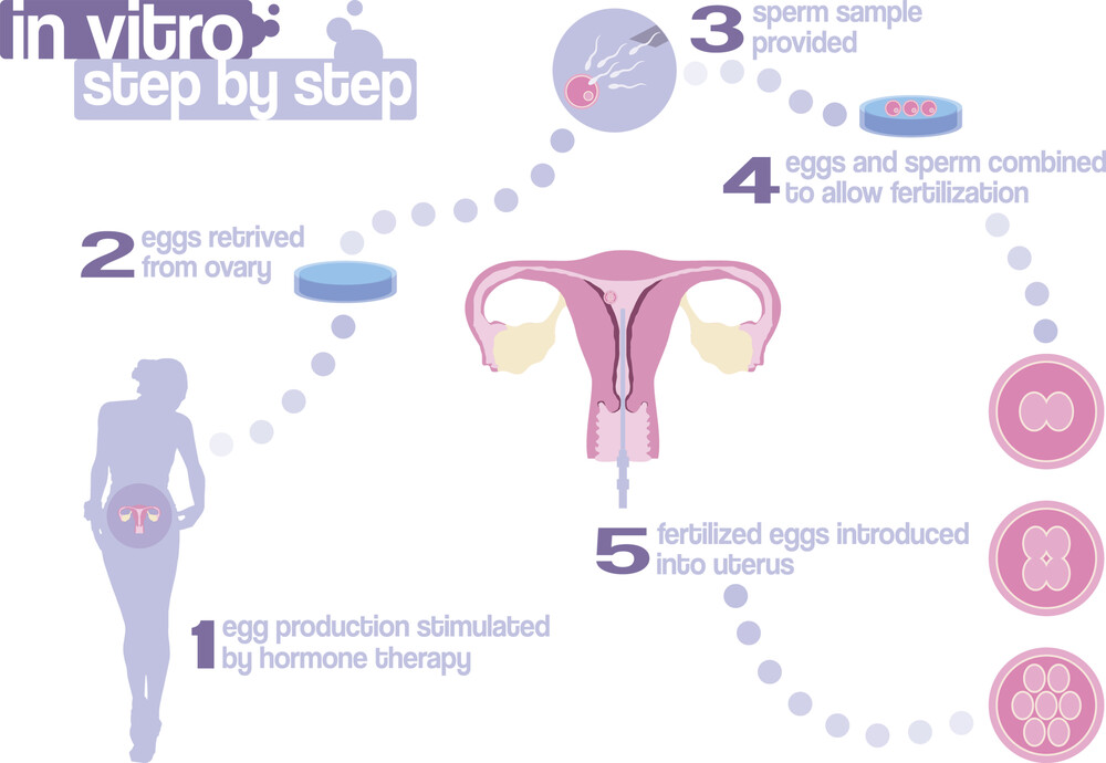 In Vitro Fertilisation (IVF) | Sims IVF